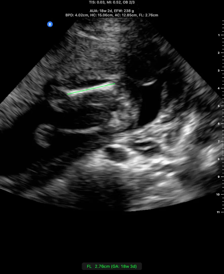 Butterfly obstetric ultrasound image showing a fetal femur length measurement of 2.76 cm. 
