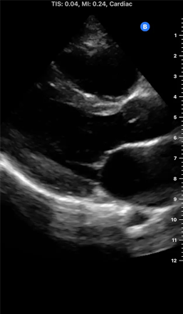 an ultrasound image of a Cardiac - Parasternal Long