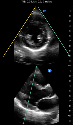an ultrasound image of a Cardiac BiPlane PLAX/PSAX