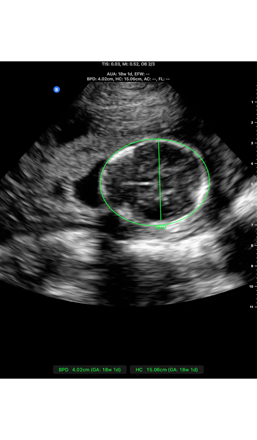 ultrasound image of a Fetal Biometry: BPD/HC