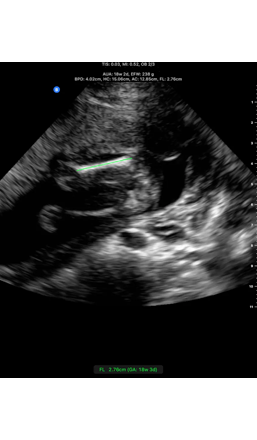 ultrasound image of a Fetal Biometry: Femur Length (FL)