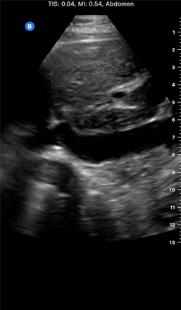 an ultrasound image of an Inferior Vena Cava