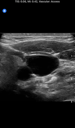 Ultrasound image of an Internal Jugular Vein