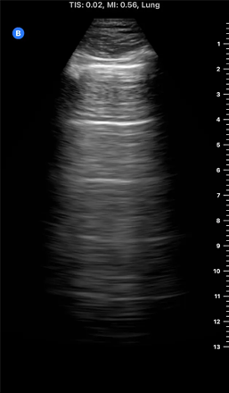 an ultrasound image of a Lung - A-Lines