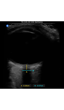 ultrasound image of an Optic Nerve
