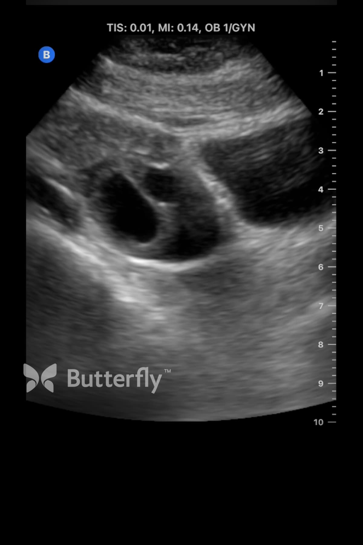 Butterfly ultrasound image of an ovary with visible follicles.