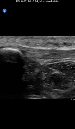 ultrasound image of a patellar tendon