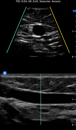 Ultrasound images of a Peripheral Vein - Vascular Access Biplane