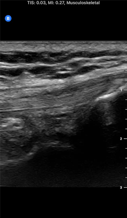 ultrasound image of a Quadriceps Tendon