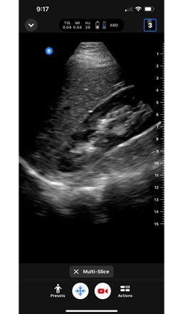 ultrasound image of a Right Upper Quadrant - iQ Slice