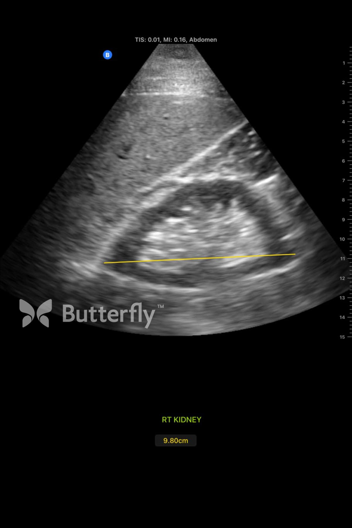 Butterfly abdominal ultrasound image showing right kidney length measurement.