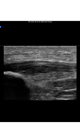 ultrasound image of a Tendinosis Patellar Tendon