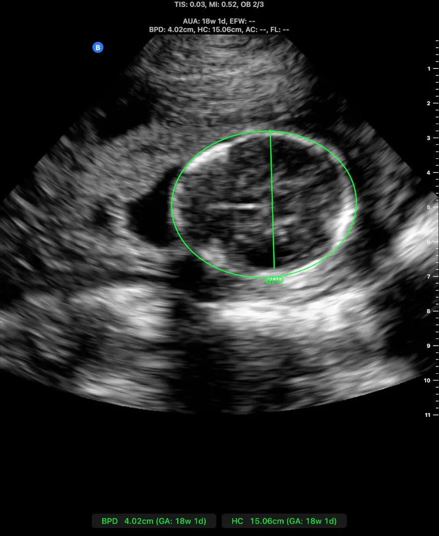 Butterfly obstetric ultrasound image showing fetal biometry measurements for BPD and head circumference.