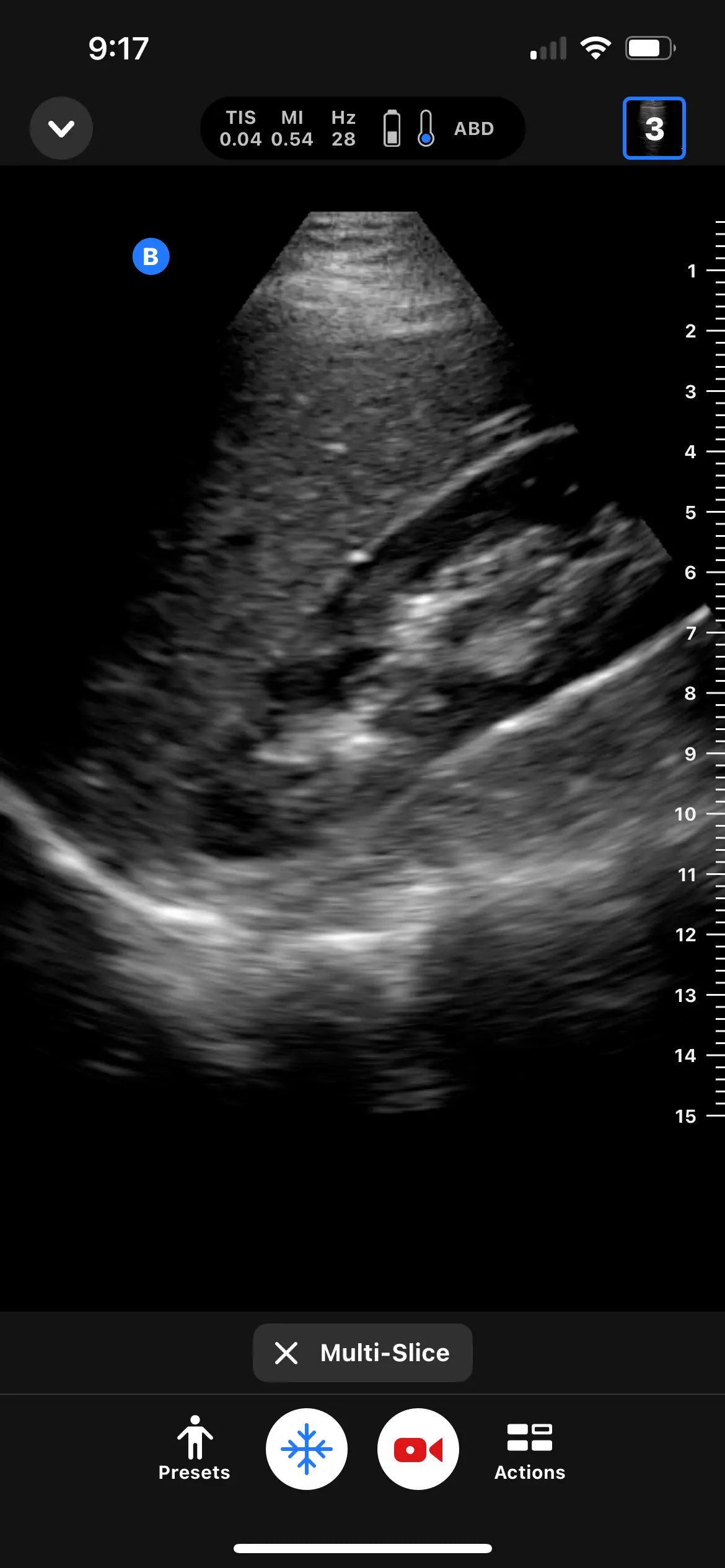 Butterfly abdomen ultrasound image shown in multi-slice mode.