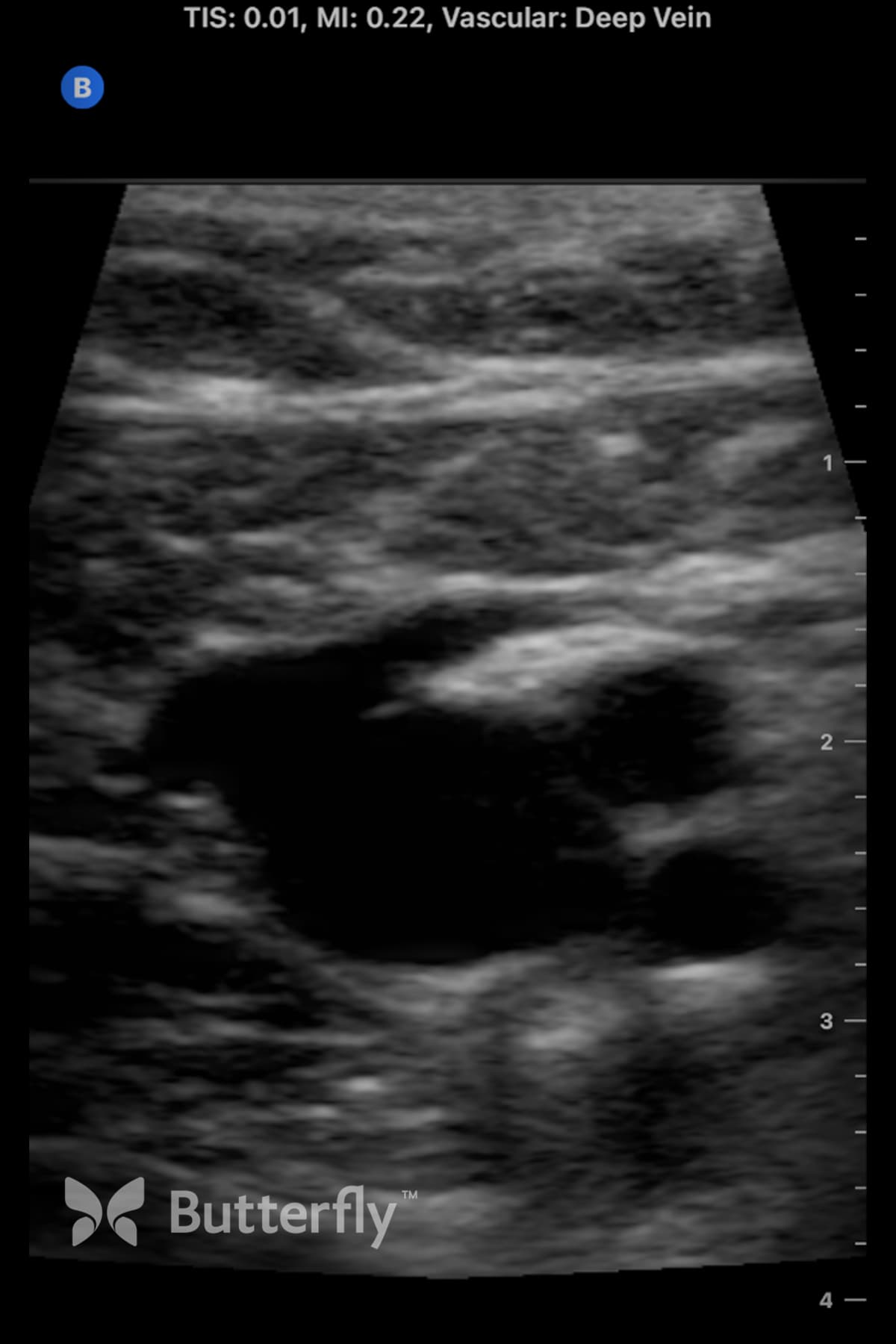 Butterfly vascular ultrasound image showing the common femoral vein.