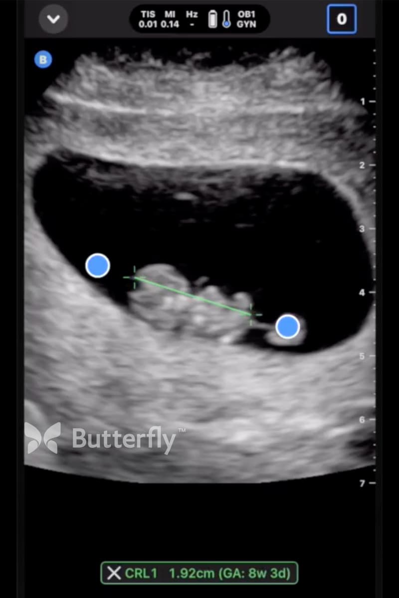 Butterfly ultrasound image showing a crown-rump length measurement of 1.92 cm