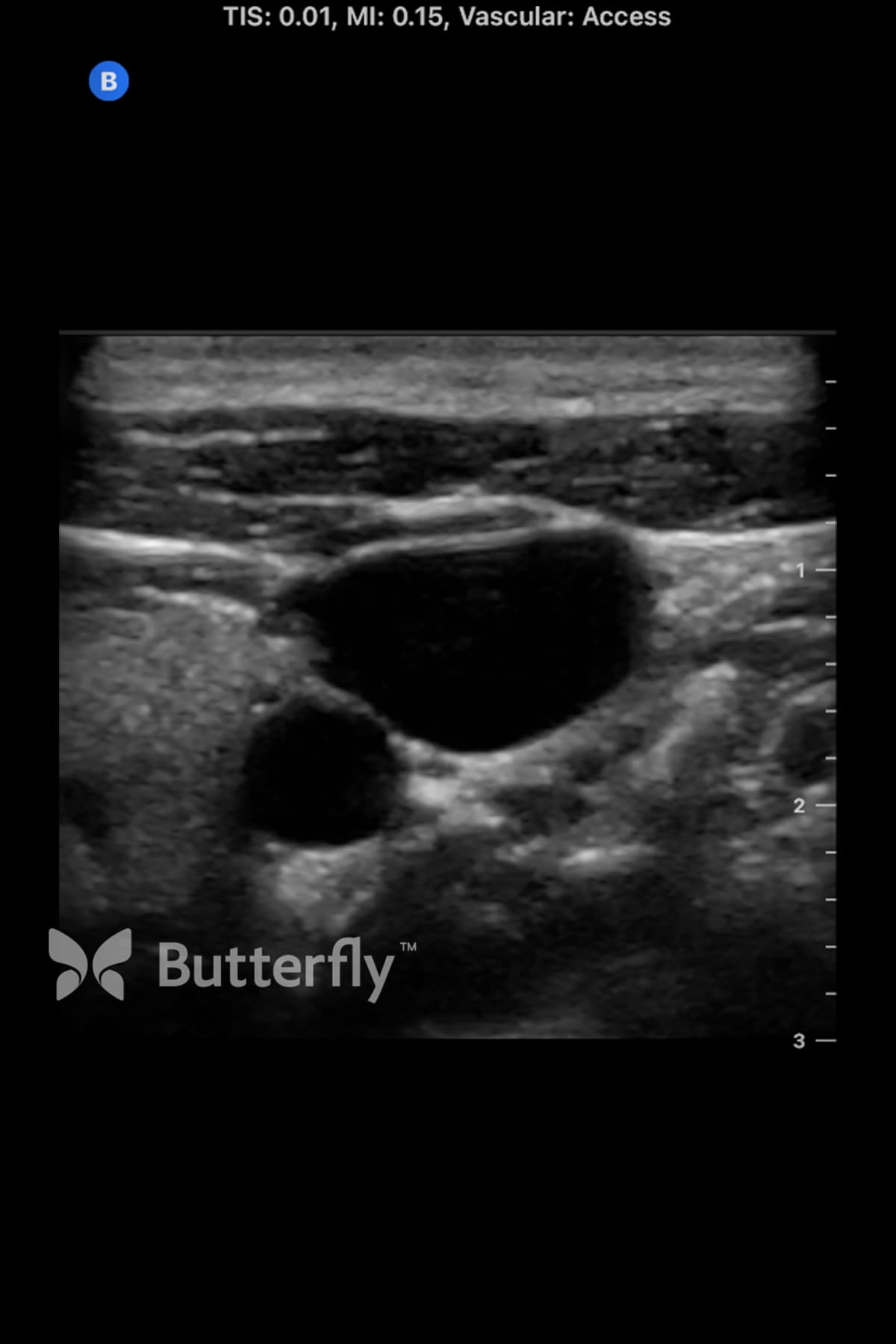 Butterfly vascular access ultrasound image showing the internal jugular vein. 