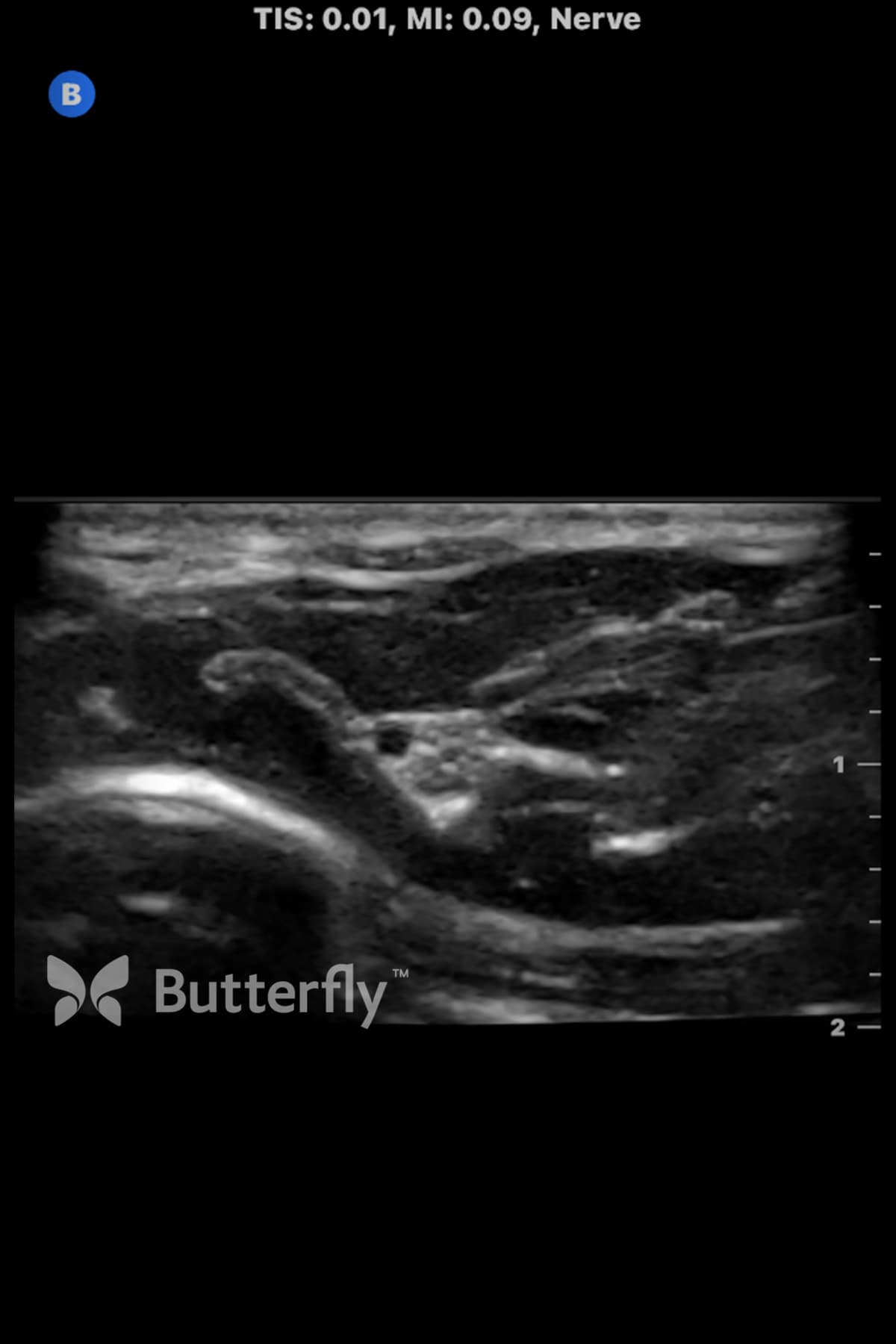 Butterfly nerve ultrasound image showing the median nerve with nearby artery.