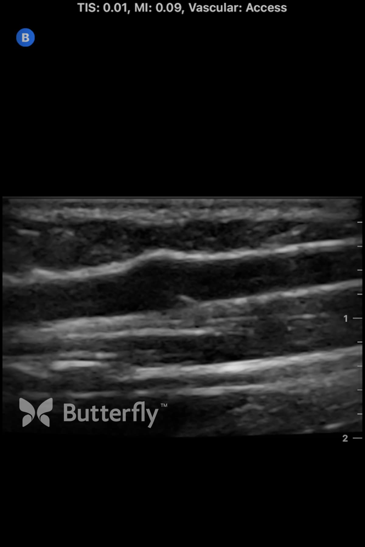 Butterfly vascular access ultrasound image showing a peripheral vein valve.