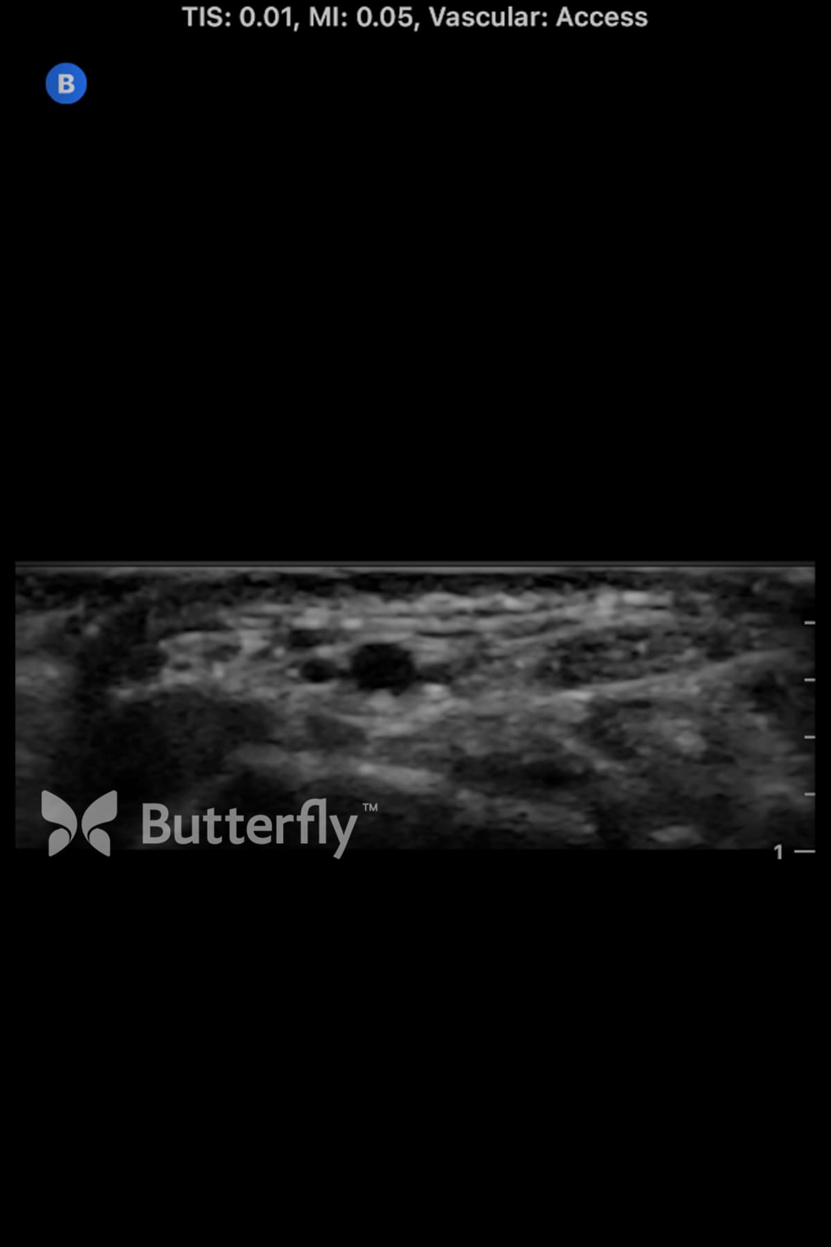 Butterfly vascular access ultrasound image showing the radial artery and veins.