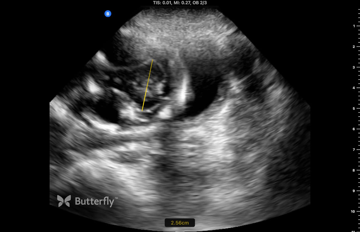 Butterfly obstetric ultrasound image showing a transcerebellar diameter measurement of 2.56 cm. 