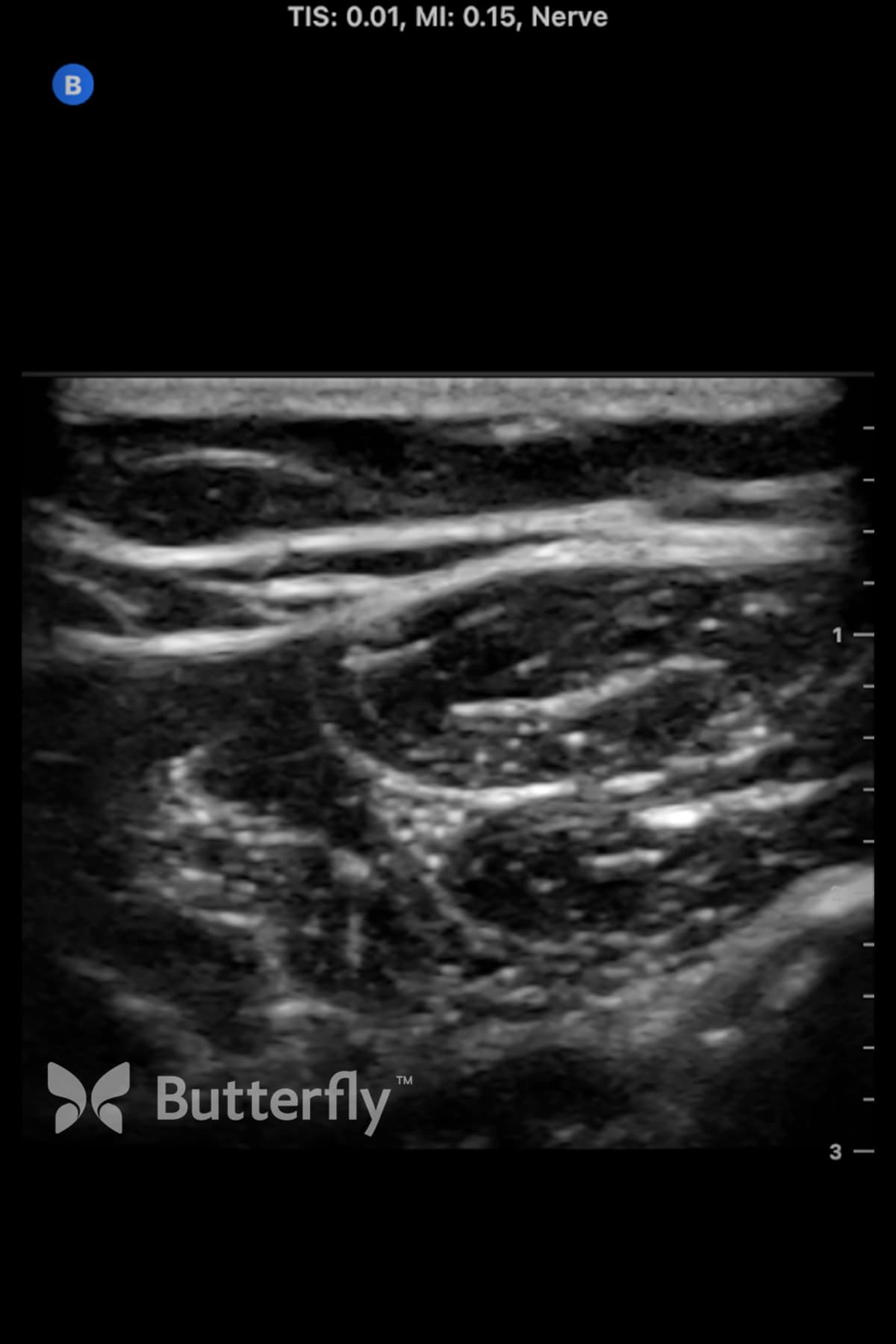 Butterfly nerve ultrasound image showing the ulnar nerve.
