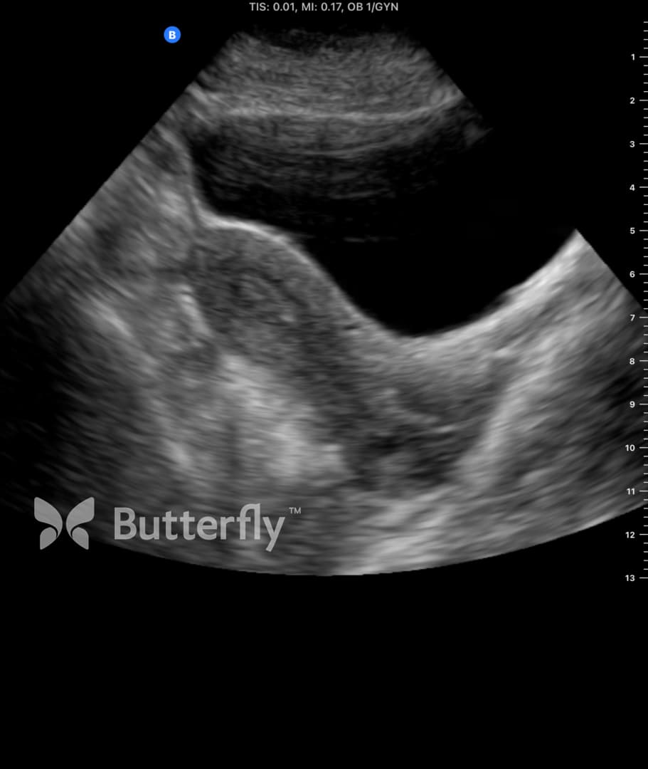 Butterfly OB/GYN ultrasound image showing a long-axis uterus view